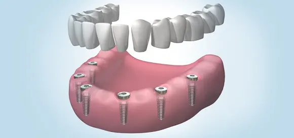 Clínica Dental Implantdent Empuriabrava - Clínica dental en Roses