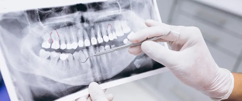 Cristina talló - Clínica dental en Figueres, Ortodoncia invisible
