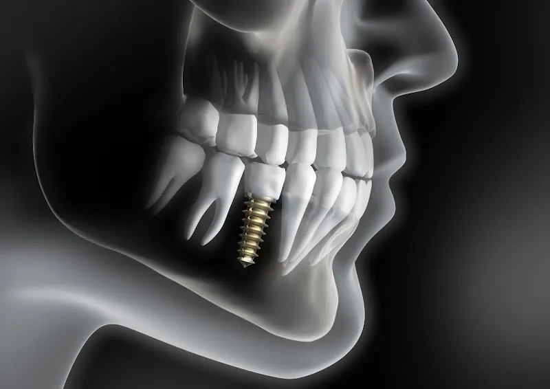 Implantes Dentales Puerta de Toledo