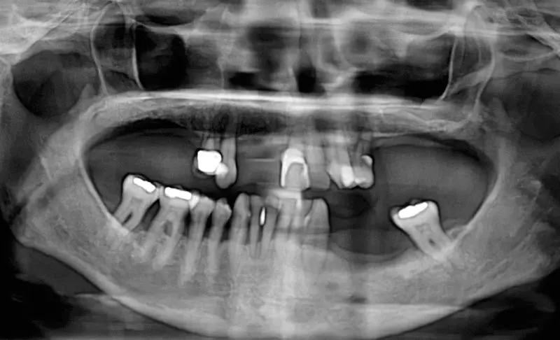 Dr Philippe Cotten / Clinica Cotten Implantes Dentales Barcelona